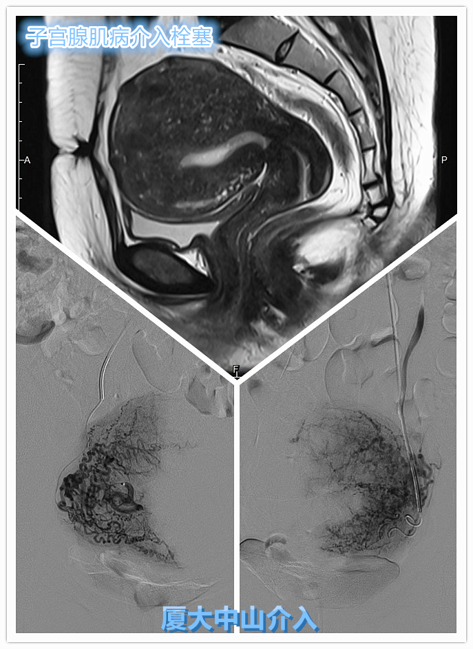 怀孕是解决子宫腺肌病的完美方案吗?