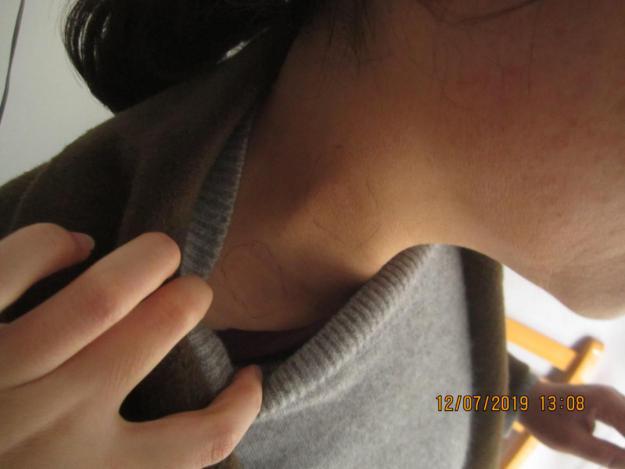 从确诊到康复,仅4个月,颈部白癜风患者王女士分享成功经验