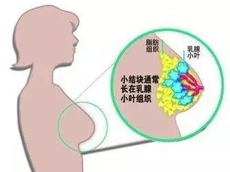 经期前乳房胀痛是乳腺增生吗,乳腺增生月经前10多天乳房胀痛