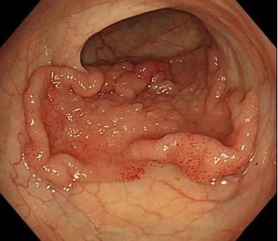 得了低位直肠癌,到底该做哪一种保肛手术?
