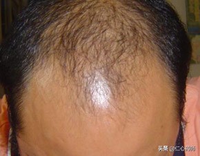 脱发真的是“无药可救”吗？其实是“有药可救”的