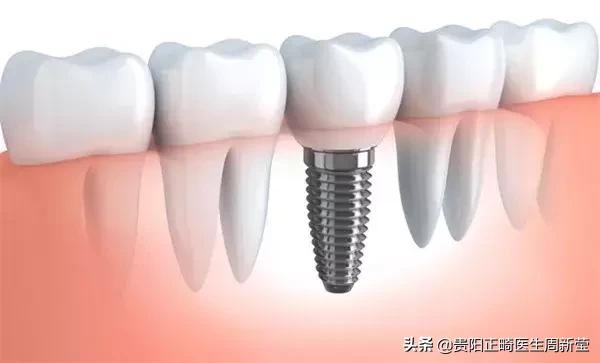牙齿松动最好的办法解决,牙齿松动怎么办才能治好