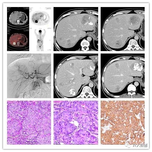 肺神经内分泌癌早期手术好吗,肺部神经内分泌肿瘤治疗