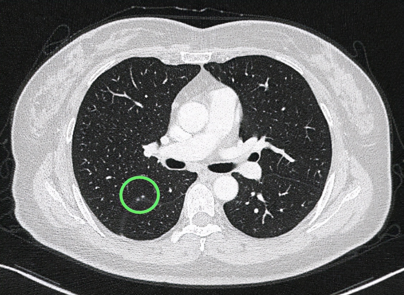 问诊分析：右下肺占位伴多发小结节，如何考虑？