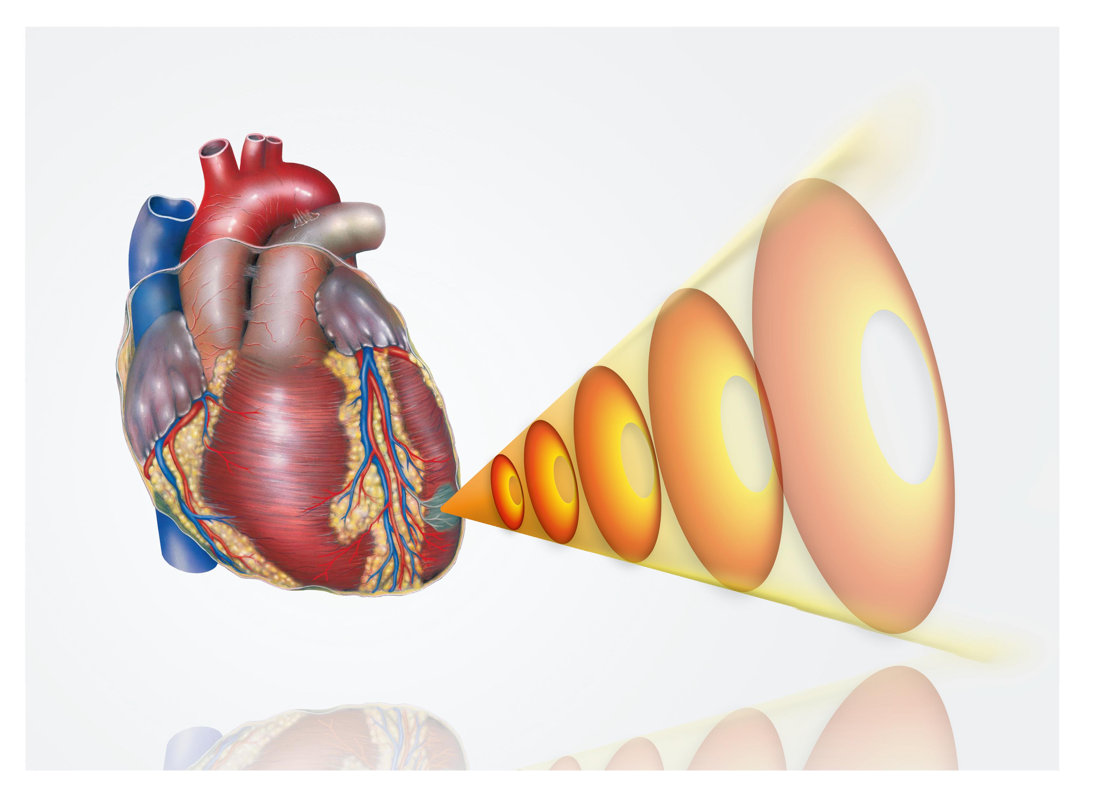 北京安贞医院程姝娟教授:心脏震波技术在心脏康复中的应用