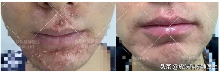 刮胡子毛囊炎凸起硬疙瘩怎么消除,刮胡子起小红点的毛囊炎怎么办