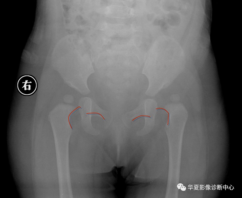 先天性髋关节脱位饮食,先天性髋关节脱位属不属于残疾人