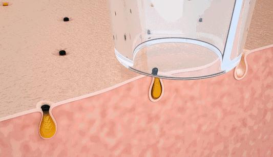 黑头拯救方法无成本,有黑头了该怎么有效去黑头