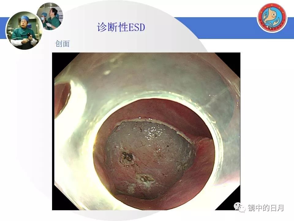 低分化胃癌早期时候做内镜手术吗,早期胃癌内镜手术后追加外科手术