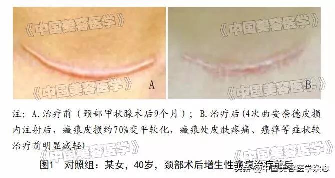 注射曲安奈德治瘢痕疙瘩,结节性痒疹曲安奈德皮下注射