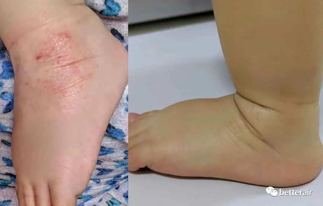 宝宝湿疹好了后一哭就变红,宝宝湿疹怕冷还是热
