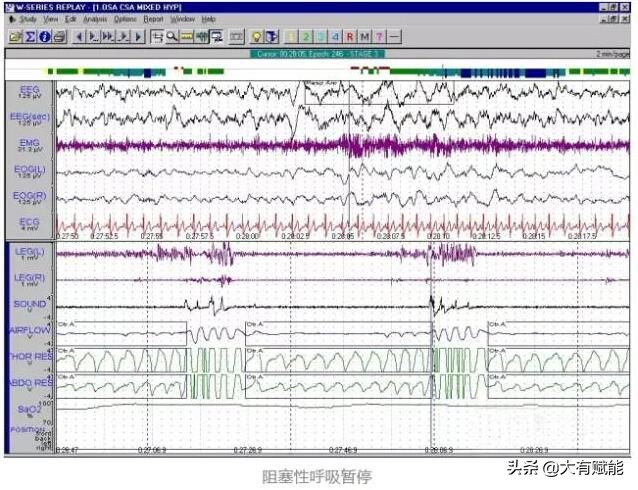 睡眠呼吸暂停监测全过程视频,深度解析呼吸暂停