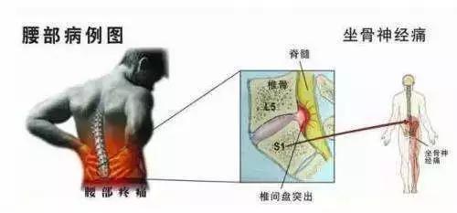 坐骨神经痛锻炼视频,坐骨神经讲解视频