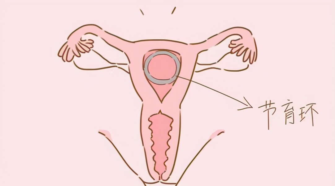避孕方法中避孕效率最高的是,避孕效果最好的是什么方法