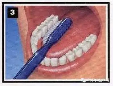 拉锯式刷牙可能造成牙齿缺损,暴力刷牙造成牙齿楔状缺损