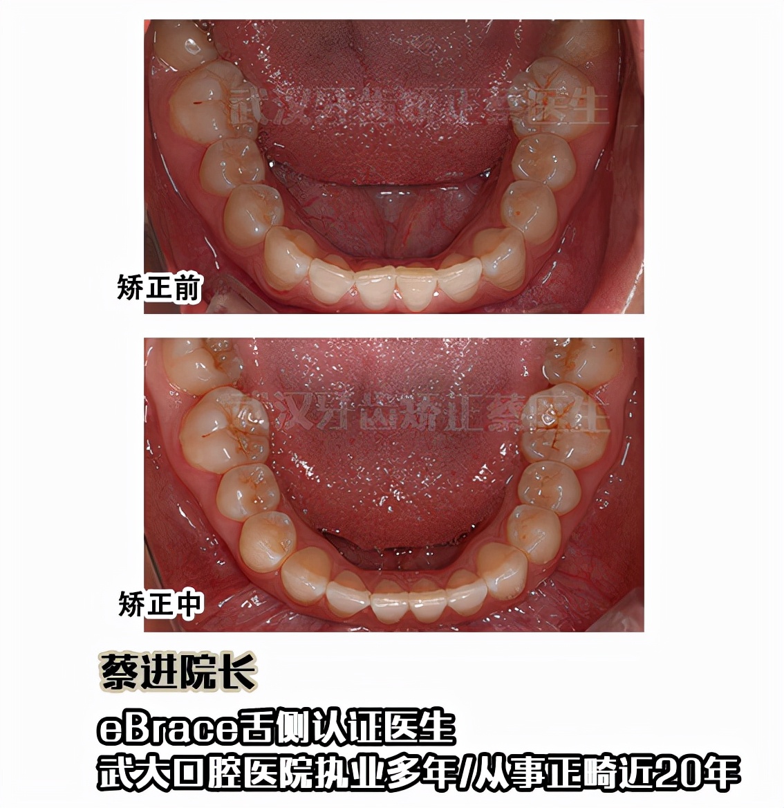 武汉矫正牙齿去哪里做最好,武汉成人牙齿矫正牙齿不齐