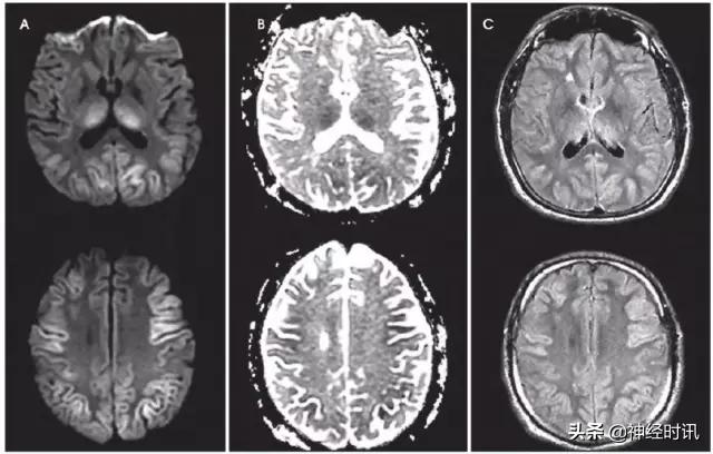 脑卒中病历诊断书图片,脑卒中影像判断技巧图解电子版
