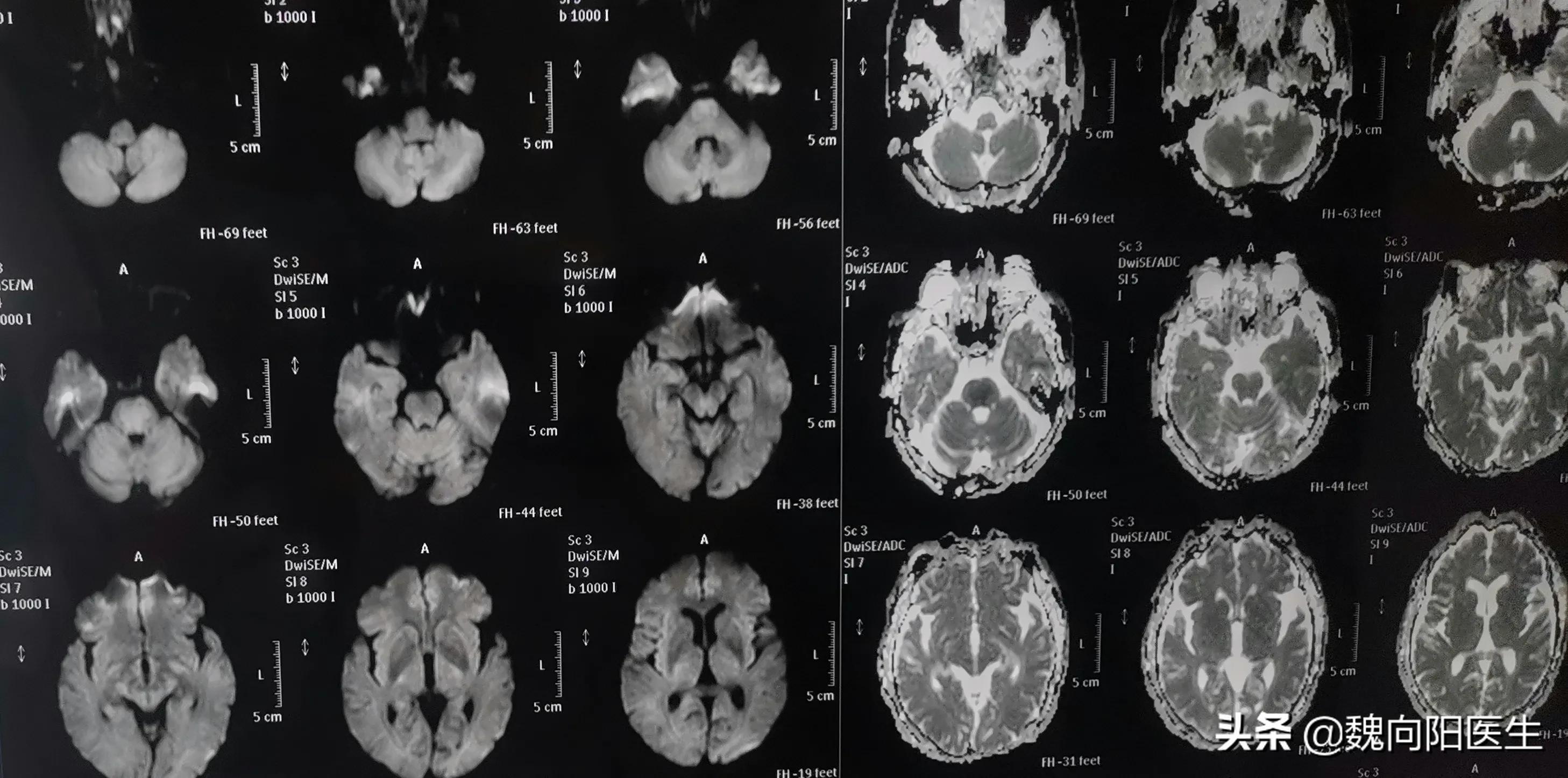 细若头发丝的椎动脉引发严重脑梗塞，开通之后希望早日康复
