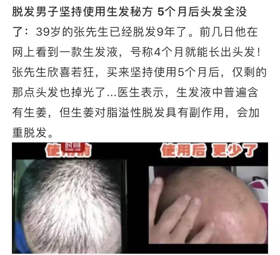 头发毛躁并且脱发推荐洗发水,用什么洗发水改善头皮脱发