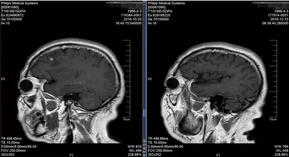 肺癌晚期可以靶向加免疫治疗吗,肺癌晚期化疗加免疫治疗有效吗