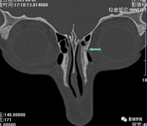 鼻骨影像学解剖,鼻骨解剖及骨折影像学诊断