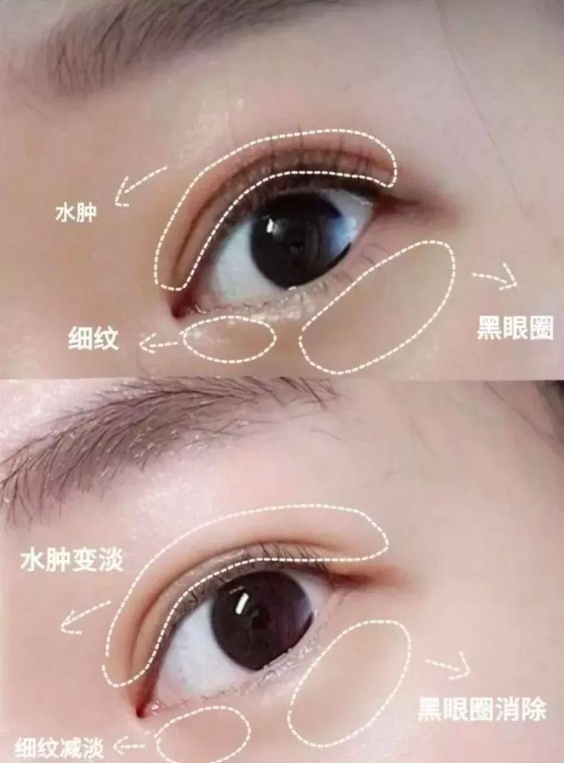 眼膜学生党去黑眼圈男生,眼膜男用