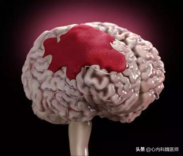 高血压引起的脑出血急救方法,高血压引起的脑出血怎么急救