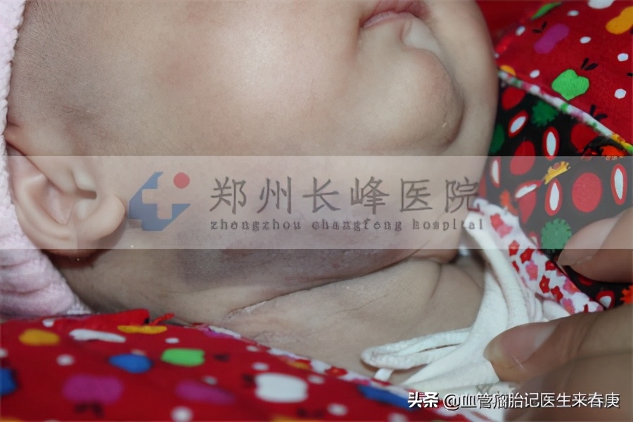 小孩脖子上的血管瘤怎么检查,如何辨别婴儿头上的血管瘤