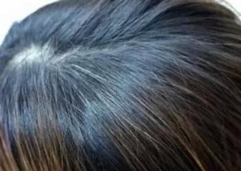 18岁高中生年纪轻轻长白发？医生：是身体出了问题