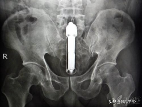 为什么会把异物塞进尿道,为什么会有人往尿道里塞异物