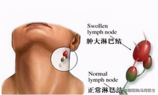 是癌吗,淋巴结癌的10个征兆