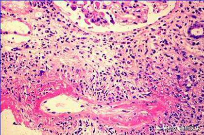 系统性血管炎怀孕能要吗,怀孕得了血管炎怎么办