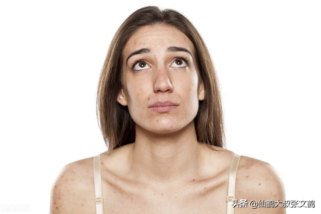 国际痘痘指南,痘痘等级划分标准图