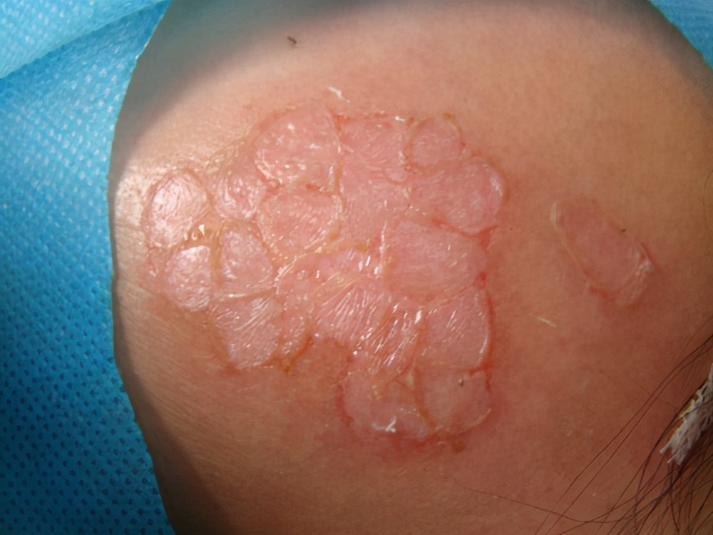 治疗白癜风到底是激光治疗好还是手术治疗好？