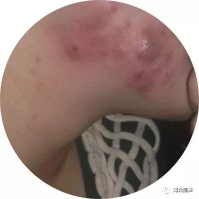 长痘痘的症状有哪些呢,长痘痘的原因及解决方法