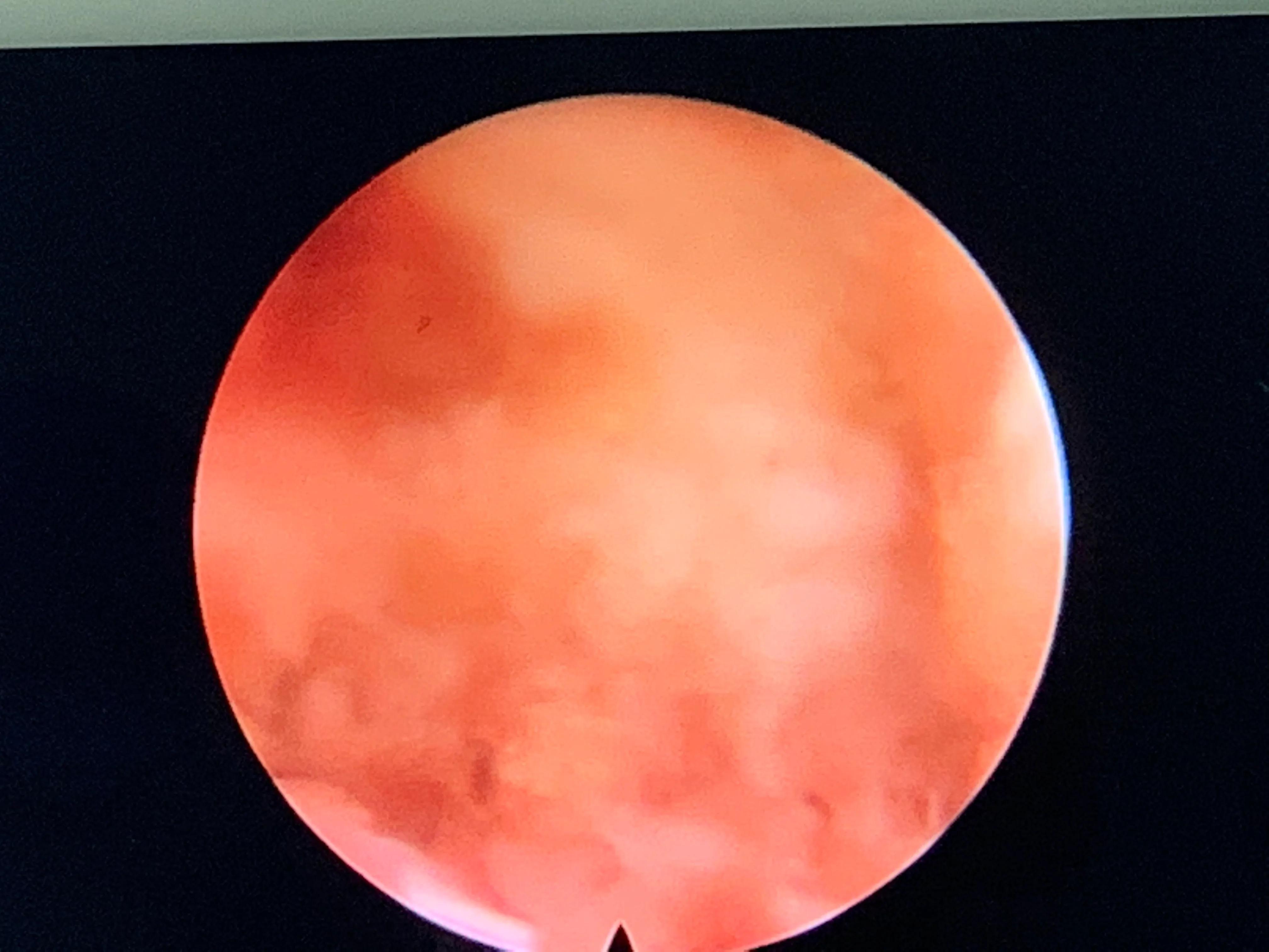 椎间孔镜术后腰痛症状多久消失,盘源性腰痛手术后易复发吗