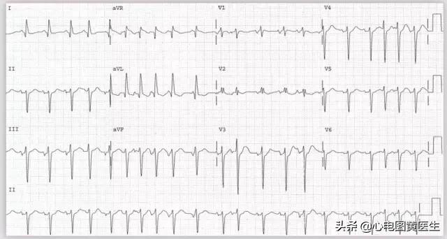 心电图分析为室性心律,房室性心动过速心电图图片