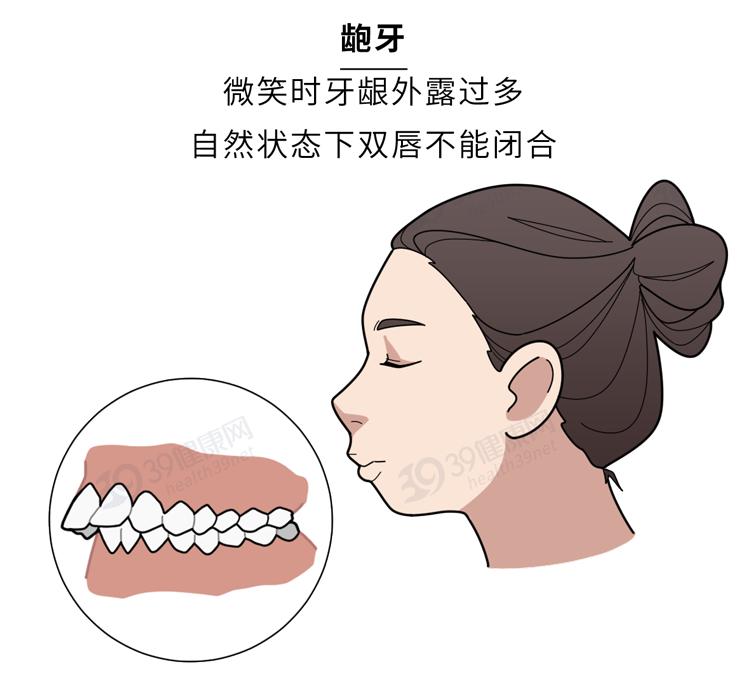 隐形牙套能矫正整齐吗,为什么戴牙套会让人变好看