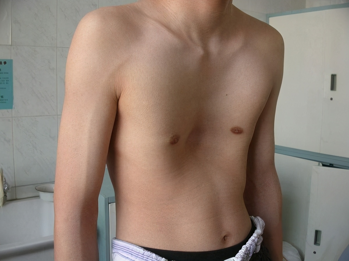 中国儿科医院漏斗胸,郴州市第一人民医院漏斗胸手术