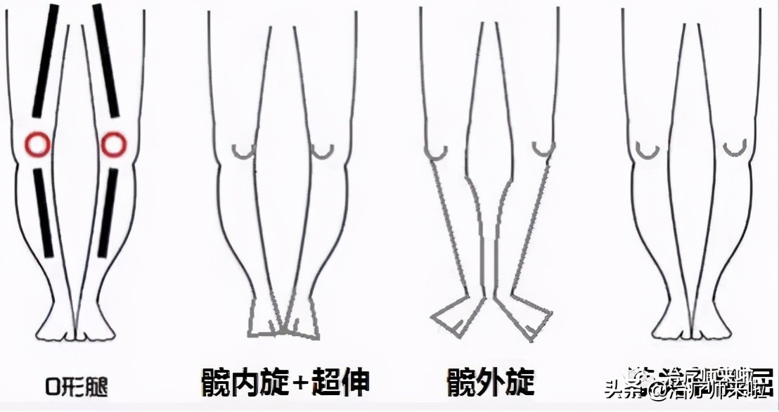 怎样可以使腿型更直,如何使腿型更好