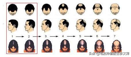 遗传性脱发的症状,遗传性脱发的原因