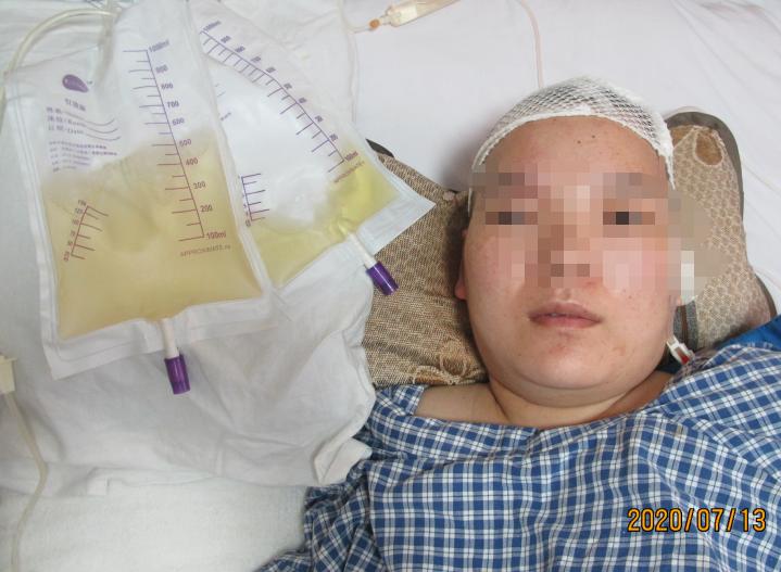 脑室有粘连脑积水有什么办法,脑动脉畸形手术后出现急性脑积水