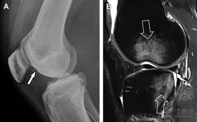 值夜班急救措施,放射科容易漏诊的骨折