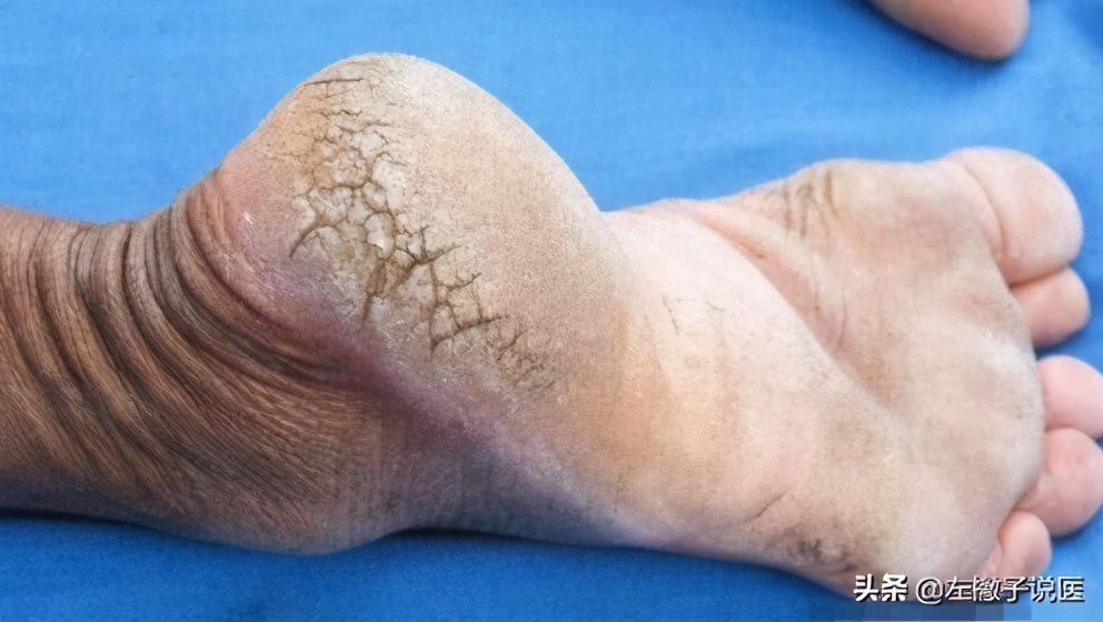 老年人冬天脚后跟开裂怎么办,脚后跟开裂冬天最快的恢复方法