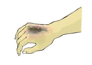 烧伤、烫伤了后如何急救，用冷水冲也讲究学问