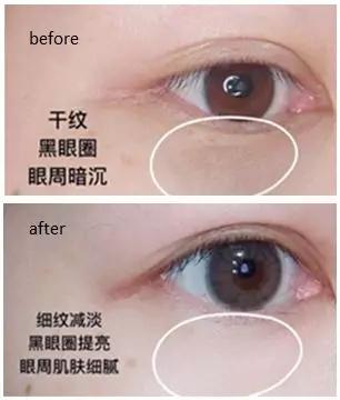 去眼纹去黑眼圈用什么方法,去眼袋眼纹公认最好用的土方法