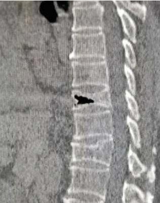 腰椎l4骨折保守治疗多久可以恢复,腰椎骨折手术还是保守治疗好