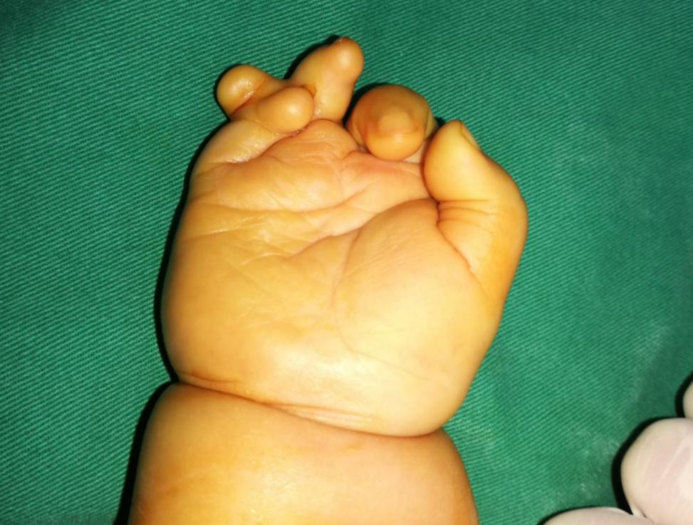 并指畸形免植皮案例,并指畸形