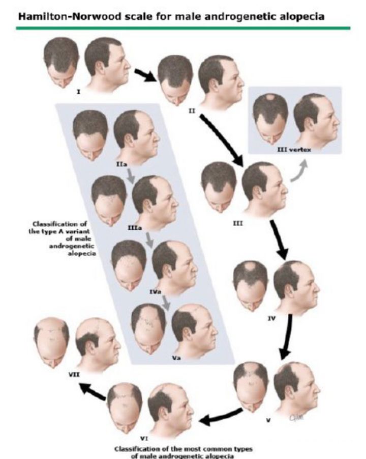 怎样辨别自己脱发,脱发判断最简单的方法