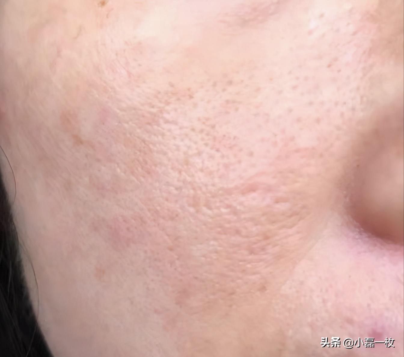 脸上长了小颗粒而且起皮特别糙,脸上皮肤又干又糙怎么办